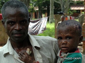 Equateur : environ 241 décès sur 3 000 cas de Monkey pox notifiés en 4 mois