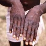 Mpox en Afrique