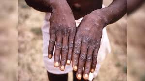 Mpox en Afrique