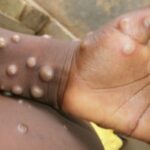 RDC/Mpox : 56 nouveaux cas confirmés à la 46ème semaine épidémiologique