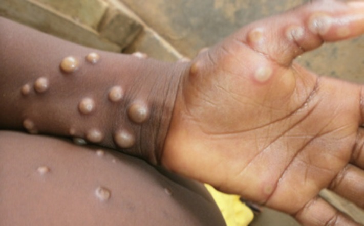 RDC/Mpox : 56 nouveaux cas confirmés à la 46ème semaine épidémiologique